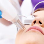 Here Are Things You Should do Before Acne Laser Treatment